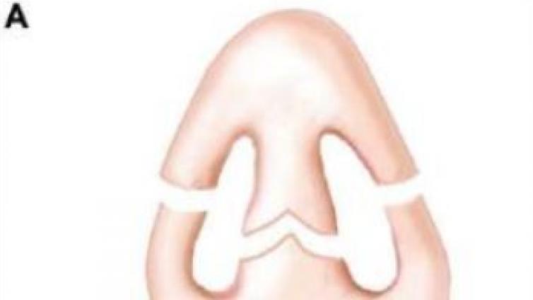 医美优质文章推荐: 鼻整形 | 下鼻基底：解剖学研究