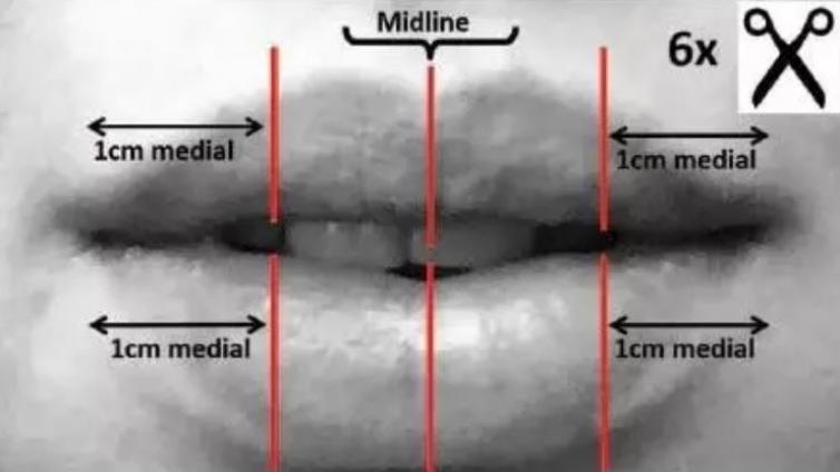 医美优质文章推荐: 上下唇动脉的解剖分布模式：对丰唇手术安全性的影响