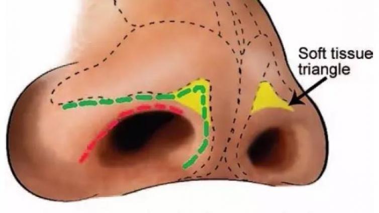 医美优质文章推荐: 如何避免鼻整形术中软组织三角区域凹陷（含视频）