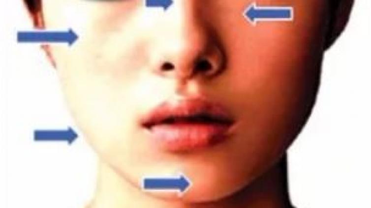 医美优质文章推荐: 永久性填充剂（爱贝芙）用于中国女性面部年轻化治疗