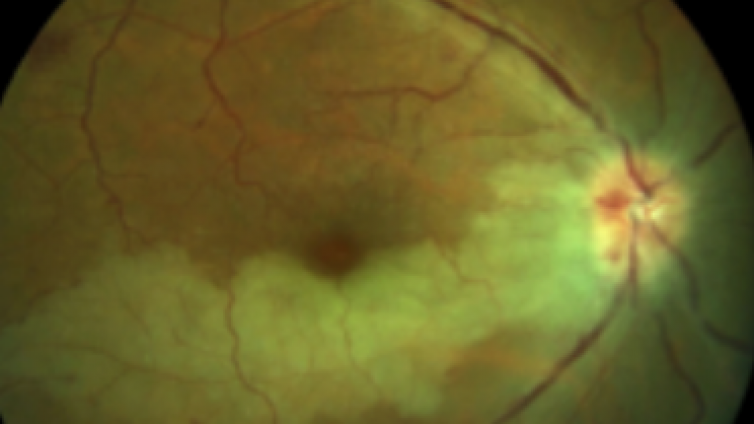 医美优质文章推荐: 病例报道-眼周肉毒毒素注射导致永久性视力丧失