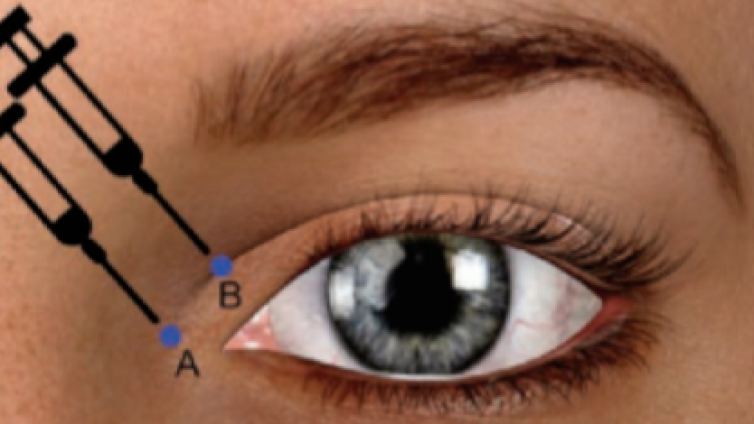 医美优质文章推荐: A型肉毒毒素在眼角手术术后早期疤痕预防中的应用总结