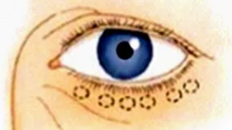 医美优质文章推荐: 眼眶解剖与眼袋年轻化修复