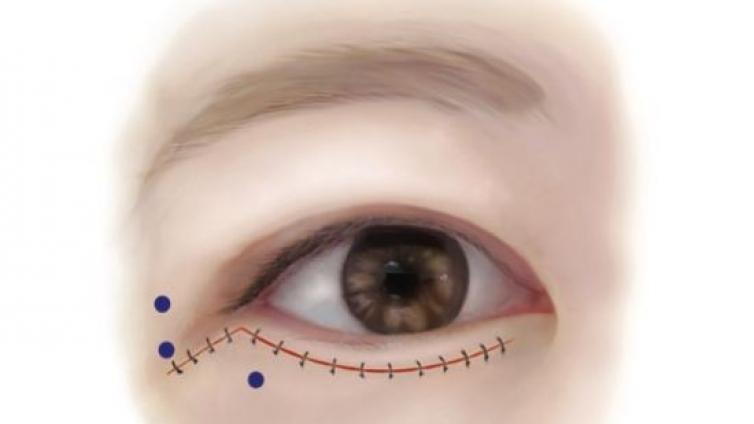 医美优质文章推荐: A型肉毒毒素改善下眼睑整形术后疤痕：一项随机双盲对照研究