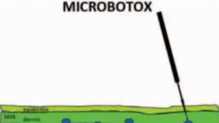 医美优质文章推荐: 细说Microbotox在下面部+颈部的紧致提升作用