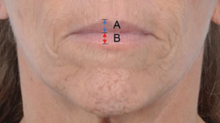 医美优质文章推荐: 上颌骨前区透明质酸注射填充在口周年轻化和唇线提升中的作用