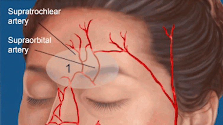 医美优质文章推荐: 面部危险区域的解剖：填充注射安全最大化