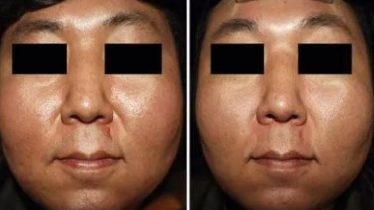 医美优质文章推荐: 低能量点阵CO2激光治疗亚洲人面部毛孔粗大效果评估