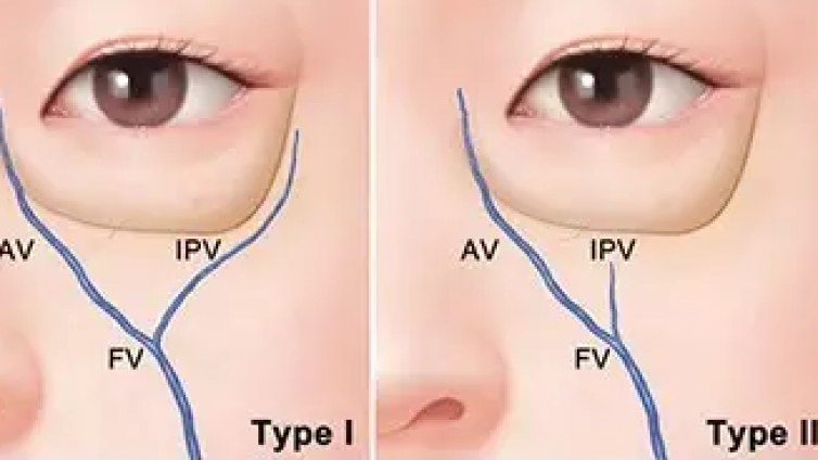 医美优质文章推荐: 注射美容：下眼睑静脉的分布模式与意义
