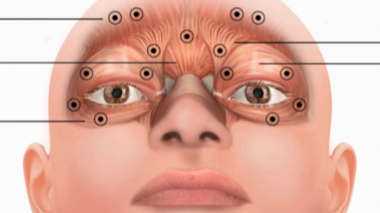 医美优质文章推荐: 肉毒毒素在眼睑痉挛及口下颌肌张力障碍中的应用总结