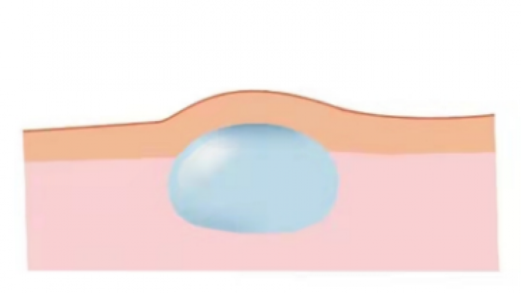 医美优质文章推荐: 面颊凹陷填充玻尿酸，如何避免移位？