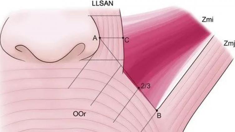 医美优质文章推荐: 高阶面部解剖 | 究竟是哪几块肌肉，参与了鼻唇沟的形成？