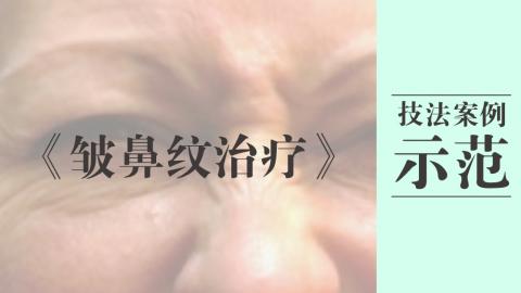 皱鼻纹治疗技法案例示范